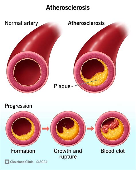 atherosclerotic aorta in tagalog|Atherosclerosis: Symptoms, Causes, Diagnosis, and .